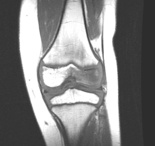 Figure 2 for case Staphylococcus osteomyelitis ( RID3715 )